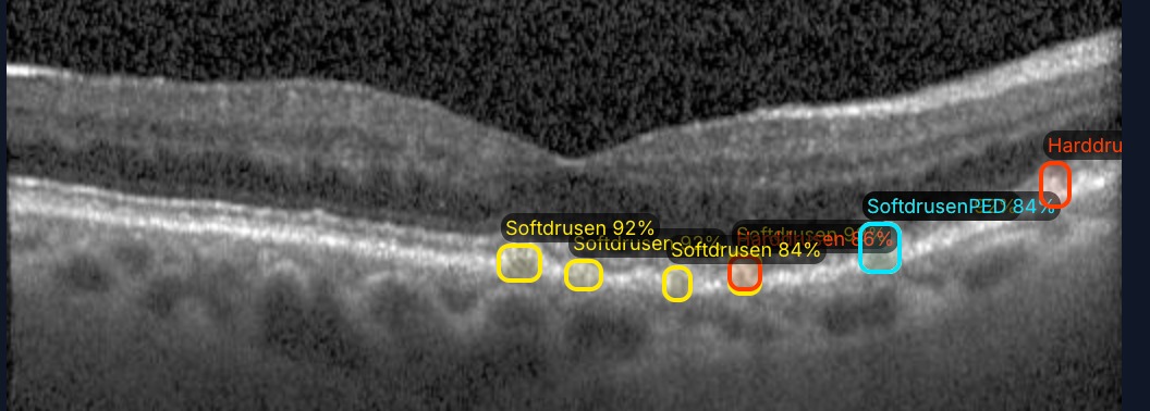 OCT scan with drusen biomarkers annotated with confidence scores